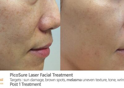 PicoSure Laser Before and After Photos Irvine CA