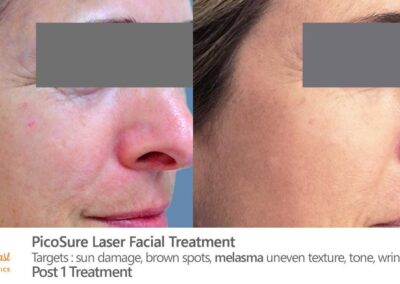 PicoSure Laser Before and After Photos Irvine CA