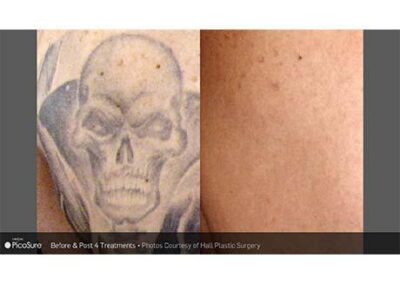 PicoSure Tattoo Removal Before and After Photos Irvine CA