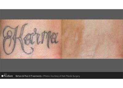 PicoSure Tattoo Removal Before and After Photos Irvine CA