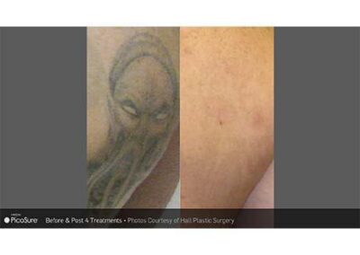 PicoSure Tattoo Removal Before and After Photos Irvine CA