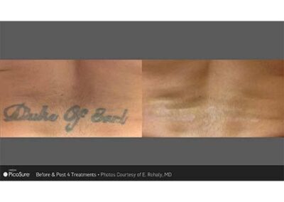 PicoSure Tattoo Removal Before and After Photos Irvine CA