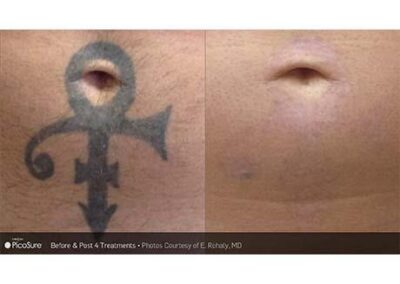 PicoSure Tattoo Removal Before and After Photos Irvine CA