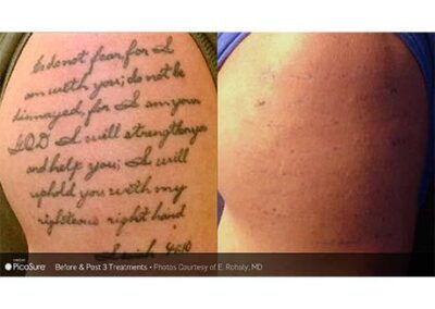 PicoSure Tattoo Removal Before and After Photos Irvine CA