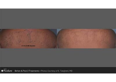 PicoSure Tattoo Removal Before & After