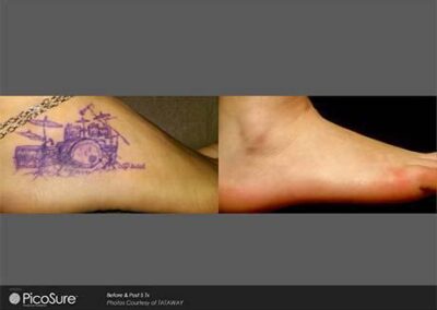 PicoSure Tattoo Removal Before and After Photos Irvine CA