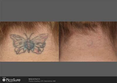 PicoSure Tattoo Removal Before and After Photos Irvine CA