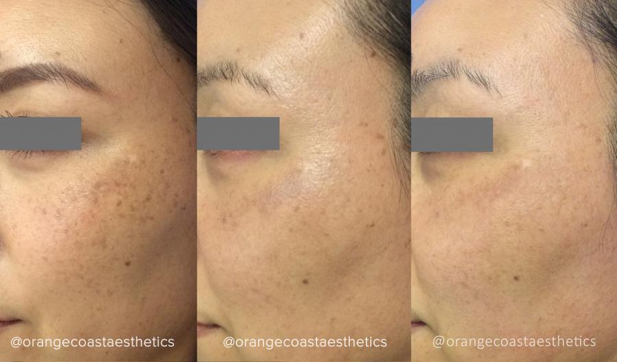 PicoSure Laser Skin Rejuvenation