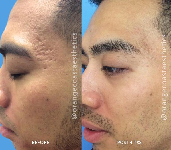 PicoSure Laser Skin Rejuvenation Results