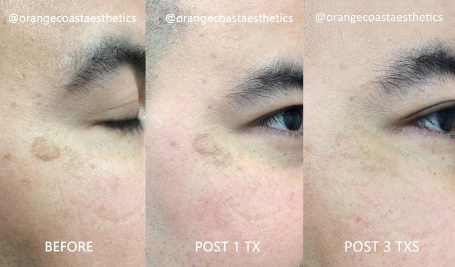 PicoSure Laser Skin Rejuvenation Results