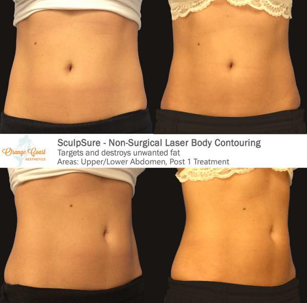 SculpSure Body Contouring