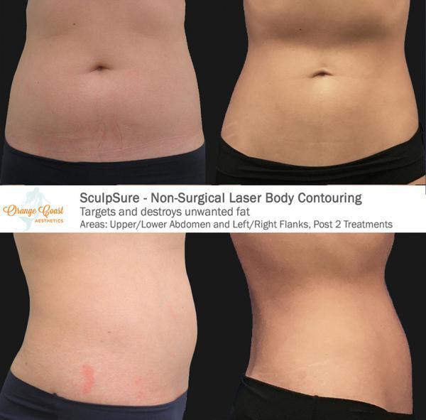 SculpSure Body Contouring