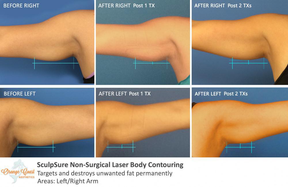 SculpSure Body Contouring