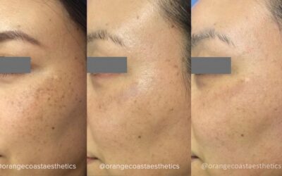 Why is PicoSure Laser Skin Rejuvenation Better for Skin
