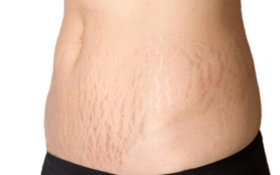 Can stretch marks be removed with laser?