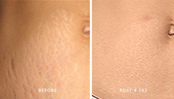 Laser Treatments for Stretch Marks