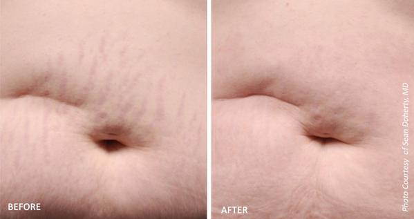 Laser Treatments for Stretch Marks