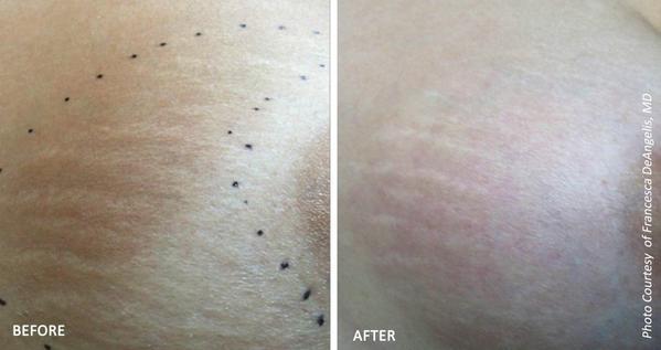 Laser Treatments for Stretch Marks