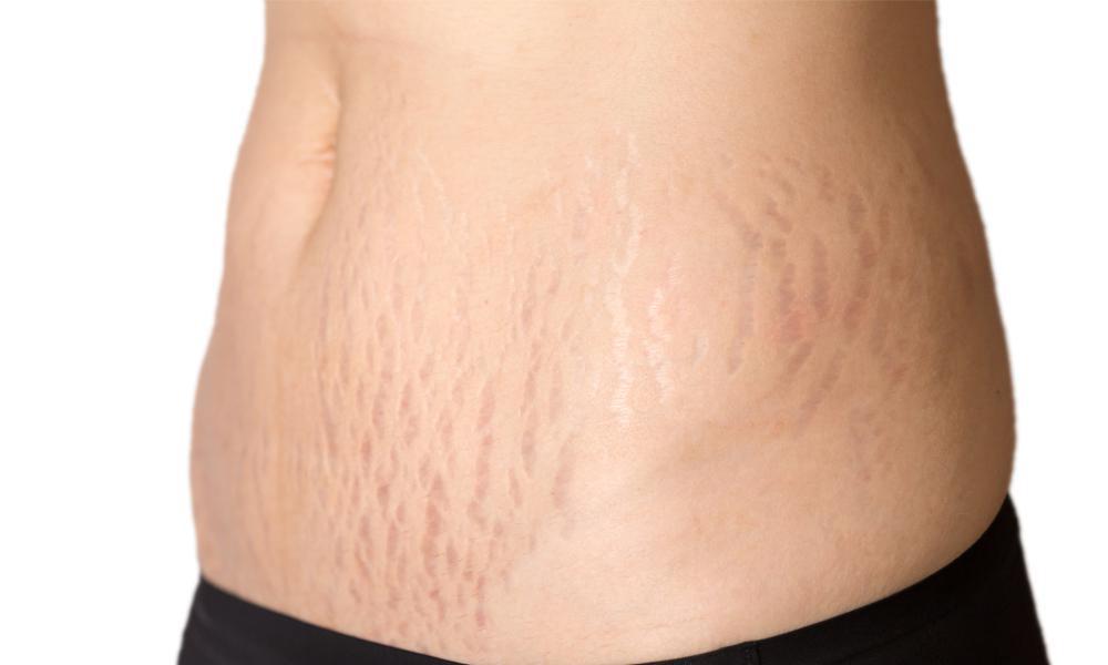 Laser Treatments for Stretch Marks