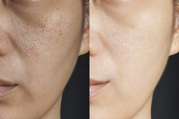 Laser Skin Treatment Irvine CA