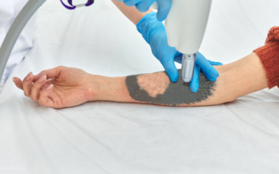 How Long Does PicoSure Tattoo Removal Take?