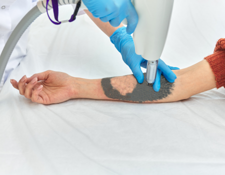 laser tattoo removal