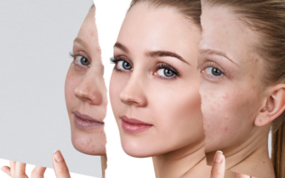 Hyperpigmentation Treatment: The Key to Healthy, Radiant Skin