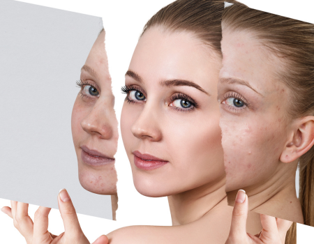 hyperpigmentation treatment in Irvine, CA